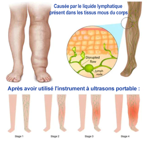 Instrument portable de soulagement lymphatique à ultrasons (50 % de réduction)